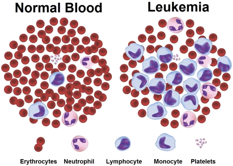LEUKIMEA CLASSIFICATION- Detection Of Blood Cancer-Leukemia Using K-means Algorithm