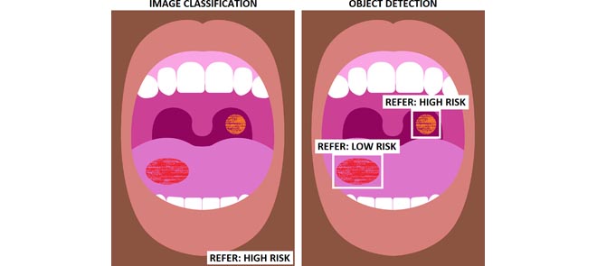 ORAL CANCER CLASSIFIIACTION USING VGG16- Automated Detection And Classification Of Oral Lesions Using Deep Learning For Early Detection Of Oral Cancer